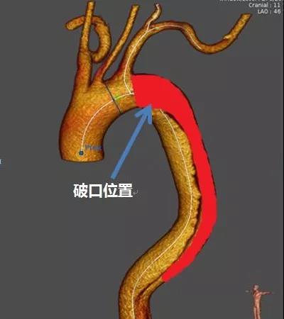 图2 使用直管型支架近端贴壁性受影响，易发内漏.jpg